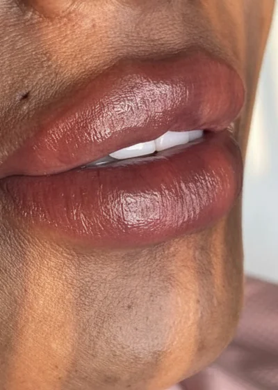 Beauty treatment results — Meraki Studio Miami